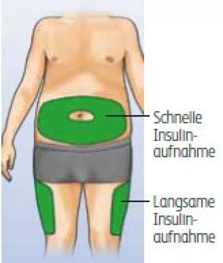 Insulininjektion: Injektionsbereiche